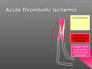 Acute Thrombotic Ischemia
                       Atherosclerosis
                           causes
                         progressive
                       narrowing of the
                         arterial tree


                         Stimulates
                       development of
                         collaterals

                       Sluggish flow &
                        rough surface
                       will favor acute
                          thrombosis
 