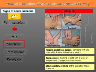 Clinical Evaluation of Acute Ischemia (Clinical Picture)

Signs of acute ischemia                         Palpation

     5Ps
Pain: symptom
Pain

      +                          Femoral             Popliteal



     Pale

  Pulseless                  Posterior tibial    Dorsalis pedis

                            Palpate peripheral pulses, compare with the
                                                  pulses
  Parasthesia               other side & write it down on a sketch

                            Temperature: the limb is cold with a level of
                            Temperature
   Paralysis                temperature change (compare the two limbs)

                            Slow capillary refilling of the skin after finger
                            pressure
 