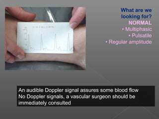 What are we
                                         looking for?
                                             NORMAL
                                          • Multiphasic
                                             • Pulsatile
                                   • Regular amplitude




An audible Doppler signal assures some blood flow
No Doppler signals, a vascular surgeon should be
immediately consulted
 