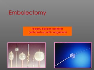 Fogarty balloon catheter
(with post-op anti coagulants)
 