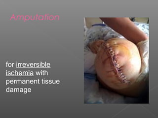 Amputation




for irreversible
ischemia with
permanent tissue
damage
 