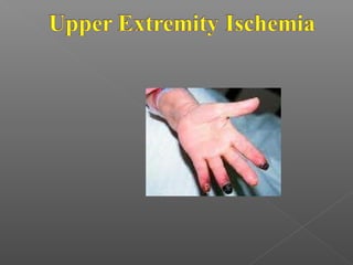Acute limb ischemia