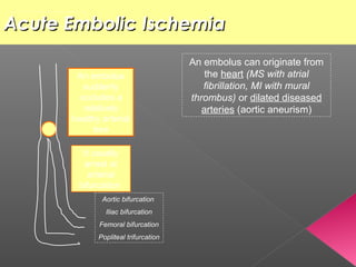 Acute Embolic Ischemia
                                      An embolus can originate from
       An embolus                         the heart (MS with atrial
         suddenly                        fibrillation, MI with mural
        occludes a                    thrombus) or dilated diseased
         relatively                      arteries (aortic aneurism)
      healthy arterial
            tree

         It usually
         arrest at
           arterial
        bifurcation
              Aortic bifurcation
               Iliac bifurcation
             Femoral bifurcation
             Popliteal trifurcation
 