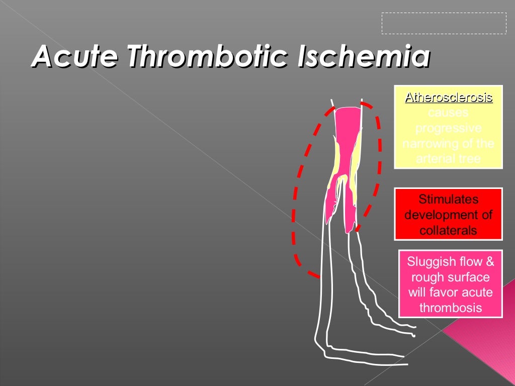 Stages Of Acute Limb Ischemia – Acute limb ischaemia: what is it ...