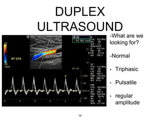 DUPLEX
ULTRASOUND
-What are we
looking for?
-Normal
• Triphasic
• Pulsatile
• regular
amplitude
19
 