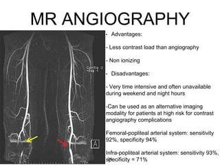 MR ANGIOGRAPHY
• Advantages:
- Less contrast load than angiography
- Non ionizing
• Disadvantages:
- Very time intensive and often unavailable
during weekend and night hours
-Can be used as an alternative imaging
modality for patients at high risk for contrast
angiography complications
Femoral-popliteal arterial system: sensitivity
92%, specificity 94%
Infra-popliteal arterial system: sensitivity 93%,
specificity = 71%24
 