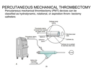 PERCUTANEOUS MECHANICAL THROMBECTOMY
Percutaneous mechanical thrombectomy (PMT) devices can be
classified as hydrodynamic, rotational, or aspiration throm- bectomy
catheters
29
 