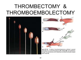 THROMBECTOMY &
THROMBOEMBOLECTOMY
32
 