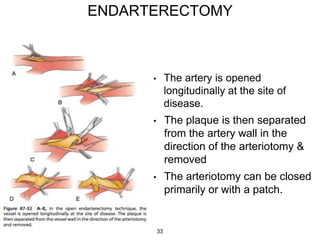 ENDARTERECTOMY
• The artery is opened
longitudinally at the site of
disease.
• The plaque is then separated
from the artery wall in the
direction of the arteriotomy &
removed
• The arteriotomy can be closed
primarily or with a patch.
33
 