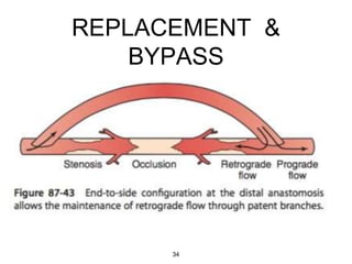 REPLACEMENT &
BYPASS
34
 