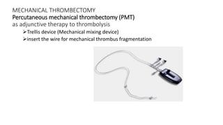MECHANICAL THROMBECTOMY
Percutaneous mechanical thrombectomy (PMT)
as adjunctive therapy to thrombolysis
Trellis device (Mechanical mixing device)
insert the wire for mechanical thrombus fragmentation
 