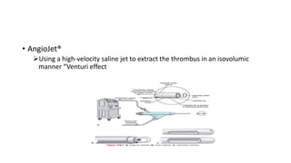 • AngioJet®
Using a high-velocity saline jet to extract the thrombus in an isovolumic
manner “Venturi effect
 