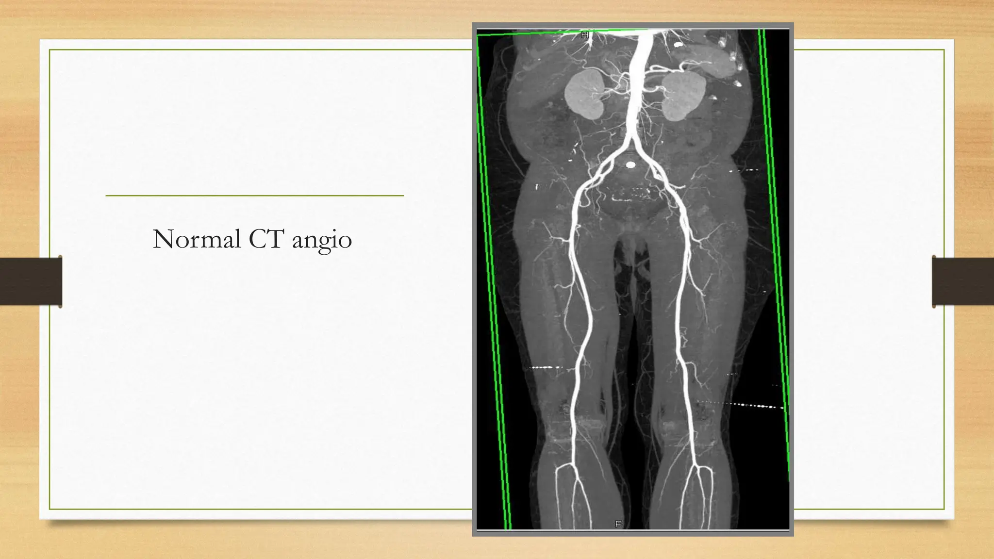 Slide of Acute limb ischemia (diagnosis, complication, management) | PPTX