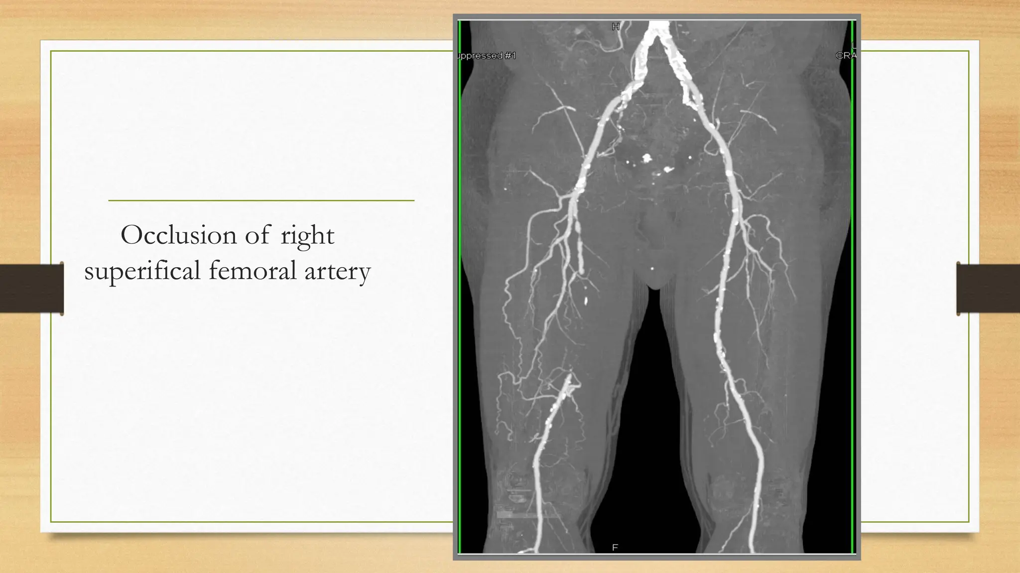 Slide of Acute limb ischemia (diagnosis, complication, management) | PPTX