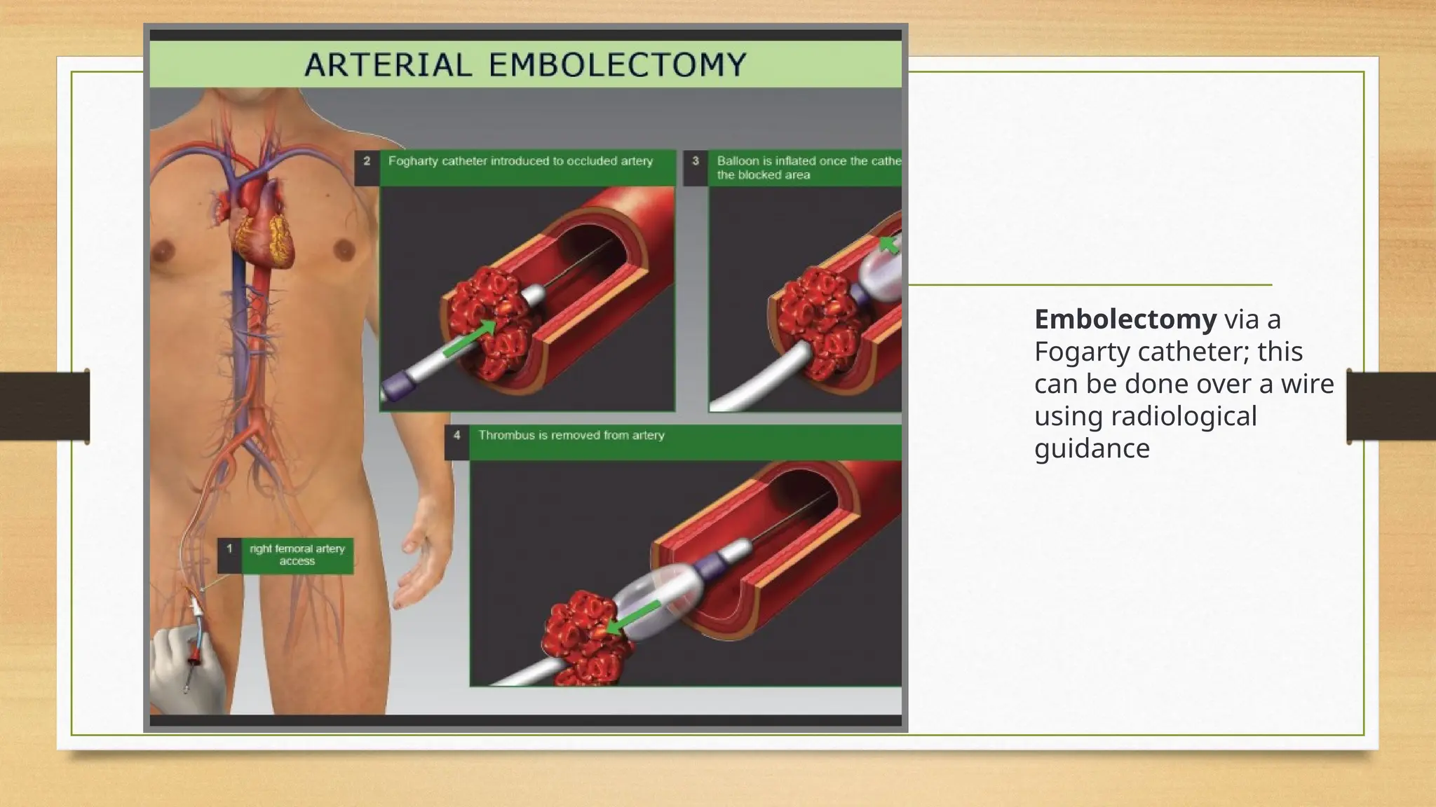 Slide of Acute limb ischemia (diagnosis, complication, management) | PPTX