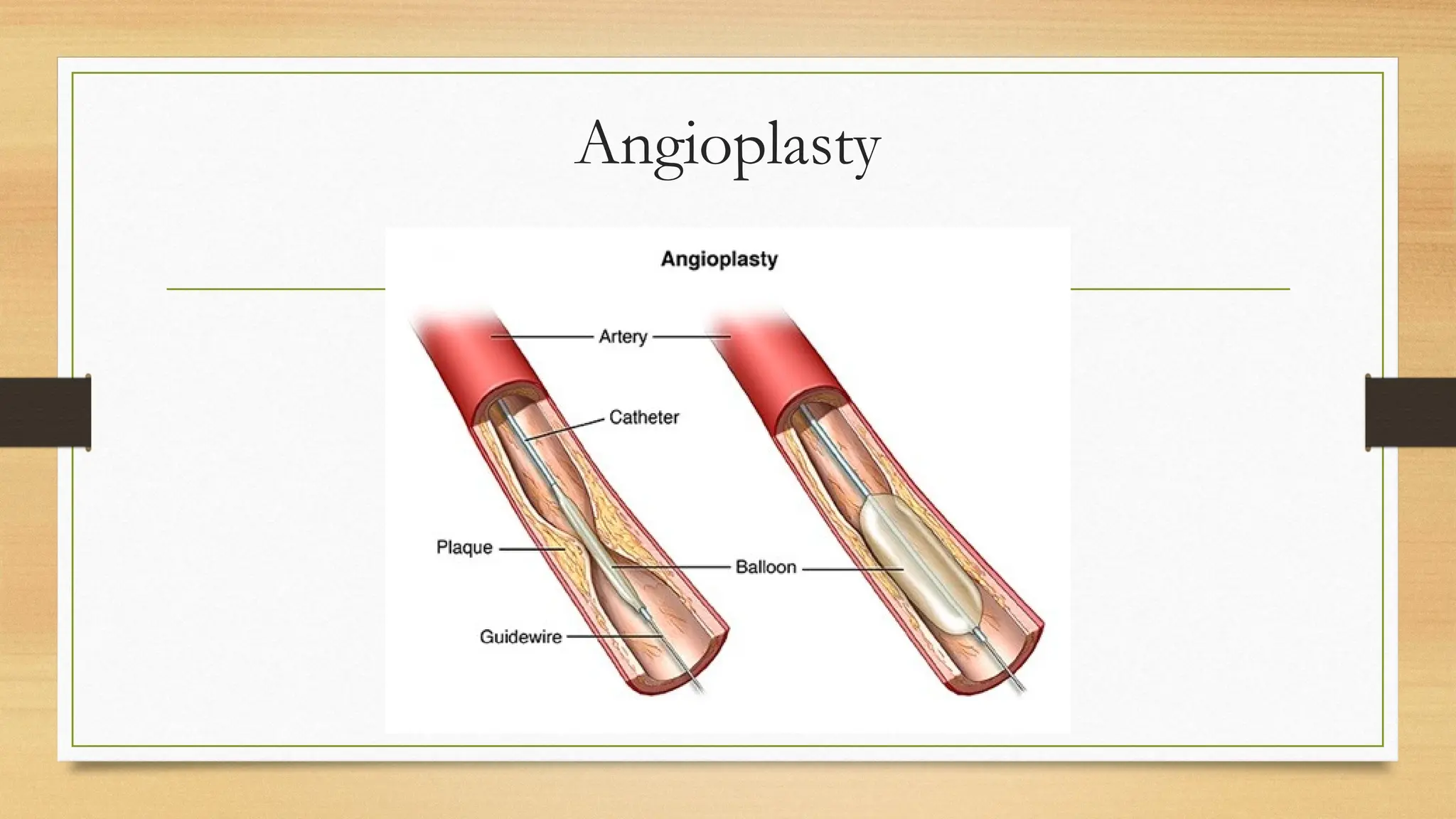 Slide of Acute limb ischemia (diagnosis, complication, management) | PPTX