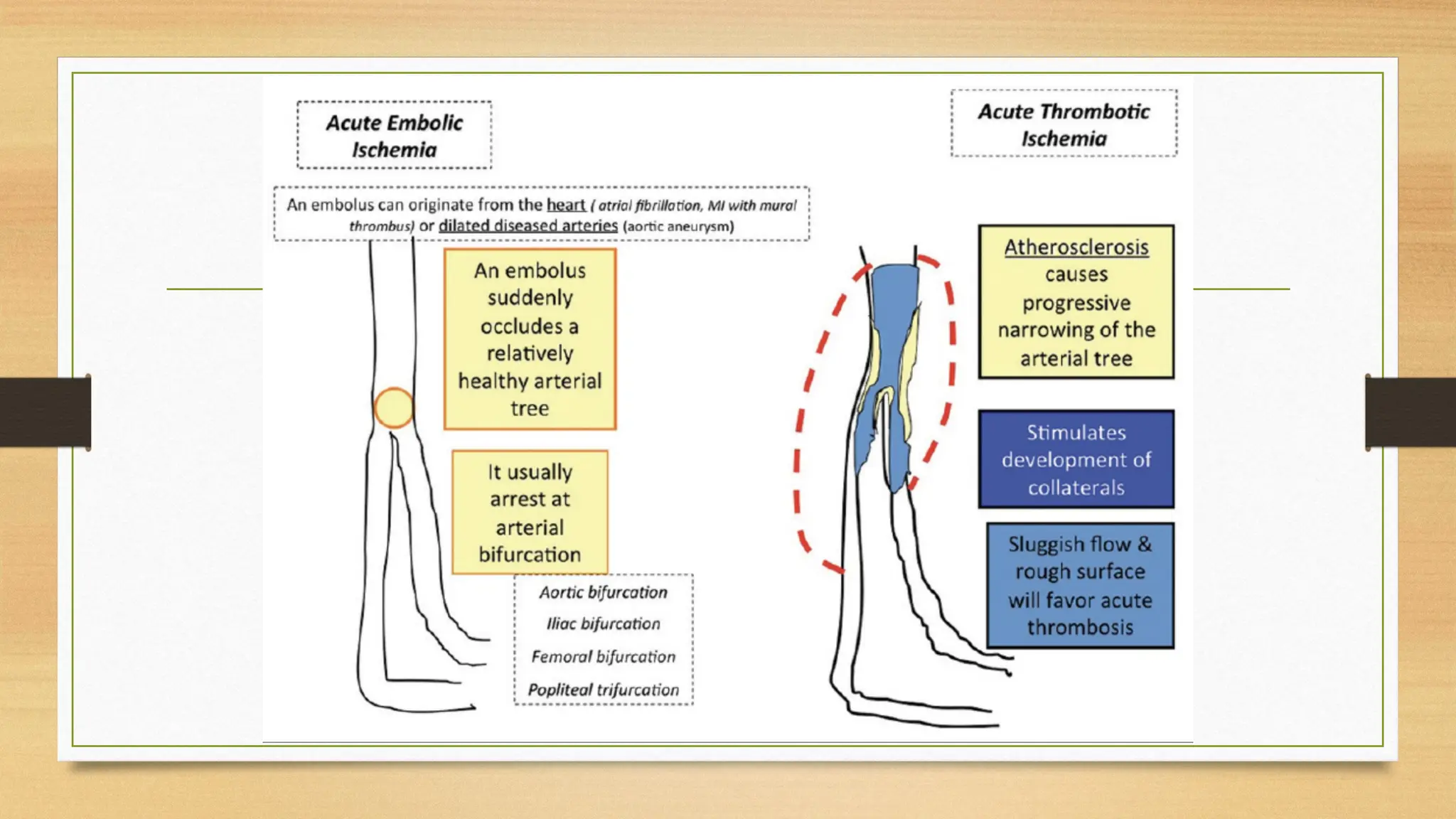 Slide of Acute limb ischemia (diagnosis, complication, management) | PPTX