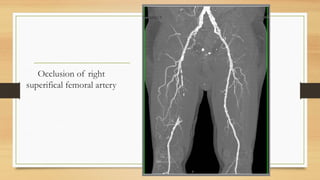 Slide of Acute limb ischemia (diagnosis, complication, management) | PPTX