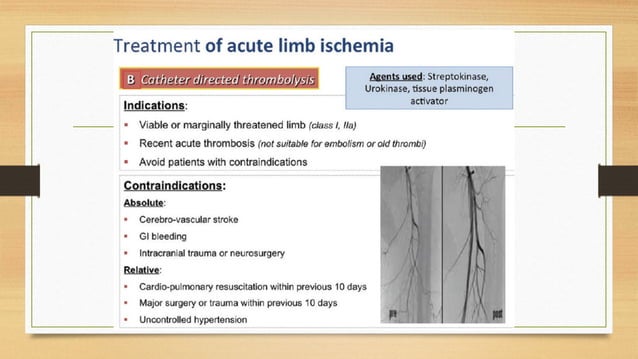 Slide of Acute limb ischemia (diagnosis, complication, management) | PPTX