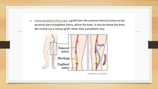 Slide of Acute limb ischemia (diagnosis, complication, management) | PPTX