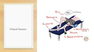 Slide of Acute limb ischemia (diagnosis, complication, management) | PPTX