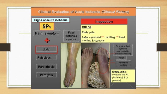 Slide of Acute limb ischemia (diagnosis, complication, management) | PPTX