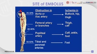 Acute Limb Ischemia and Role of DOAC.pptx