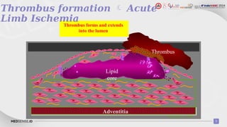 Acute Limb Ischemia and Role of DOAC.pptx