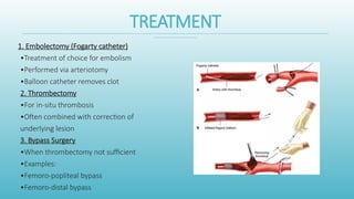Comprehensive Overview of Acute Arterial Occlusion and Limb Ischemia ...
