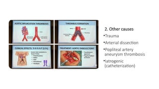 Comprehensive Overview of Acute Arterial Occlusion and Limb Ischemia ...