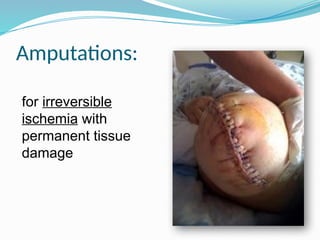 ACUTE LIMB ISCHEMIA SURGICAL management.pptx