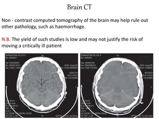 Brain CT
Non - contrast computed tomography of the brain may help rule out
other pathology, such as haemorrhage.
N.B. The yield of such studies is low and may not justify the risk of
moving a critically ill patient
 