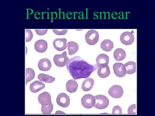Peripheral smear
 