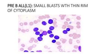 PRE B ALL(L1): SMALL BLASTS WTH THIN RIM
OF CYTOPLASM
 