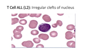 T Cell ALL (L2): Irregular clefts of nucleus
 