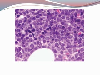 Acute lymphoblastic leukemia (ALL) dr arun haldia | PPTX