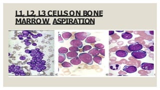 L1, L2, L3 CELLSON BONE
MARROW ASPIRATION
 
