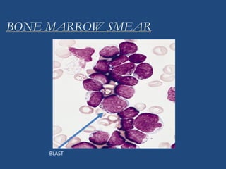 BONE MARROW SMEAR
BLAST
 