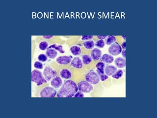 BONE MARROW SMEAR
 