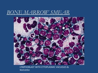 BONE MARROW SMEAR
LYMPHOBLAST WITH CYTOPLASMIC VACUOLES &
NUCLEOLI
 