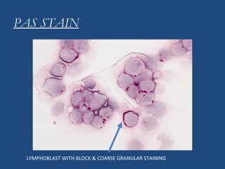 PAS STAIN
LYMPHOBLAST WITH BLOCK & COARSE GRANULAR STAINING
 