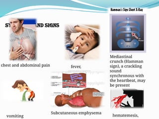 ACUTE MEDIASTINITIS dinakaran m.b.b.s.pptx