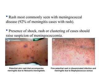  Rash most commonly seen with meningococcal
disease (92% of meningitis cases with rash).
 Presence of shock, rash or clustering of cases should
raise suspicion of meningococcemia.
Petechial skin rash that accompanies
meningitis due to Neisseria meningitidis.
Fine petechial rash in disseminated infection and
meningitis due to Staphylococcus aureus
 