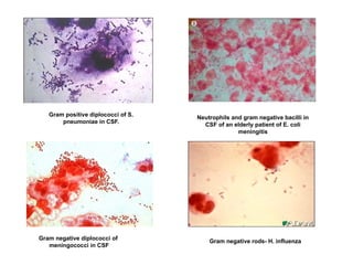 Gram positive diplococci of S.
pneumoniae in CSF.
Neutrophils and gram negative bacilli in
CSF of an elderly patient of E. coli
meningitis
Gram negative rods- H. influenza
Gram negative diplococci of
meningococci in CSF
 