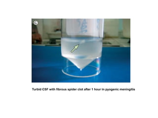Turbid CSF with fibrous spider clot after 1 hour in pyogenic meningitis
 