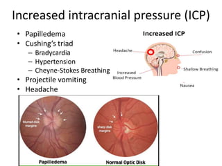 Increased intracranial pressure (ICP)
• Papilledema
• Cushing’s triad
– Bradycardia
– Hypertension
– Cheyne-Stokes Breathing
• Projectile vomiting
• Headache
 