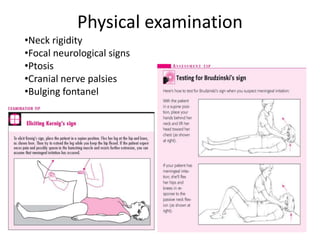 Physical examination
•Neck rigidity
•Focal neurological signs
•Ptosis
•Cranial nerve palsies
•Bulging fontanel
 