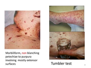 Morbiliform, non blanching
petechiae to purpura
involving mostly extensor
surfaces Tumbler test 18
 