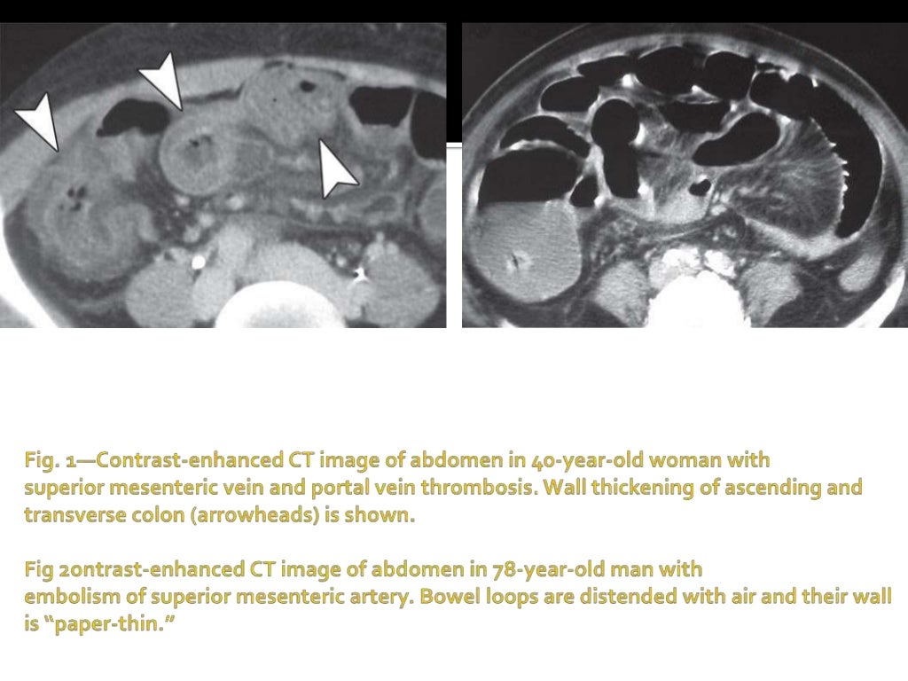 CT diagnosis of Acute mesenteric ischemia from various causes