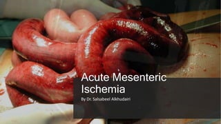 Acute Mesenteric
Ischemia
By Dr. Salsabeel Alkhudairi
 